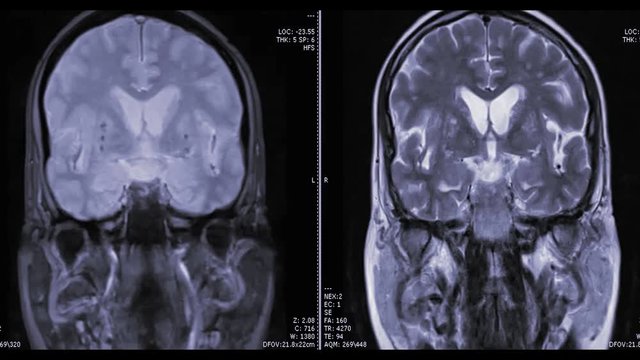 MRI brain or magnetic resonance imaging in coronal view comparison T1 vs T2  showing anatomical of the brain.