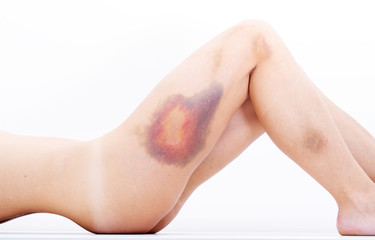 Young woman with a hematoma on hip