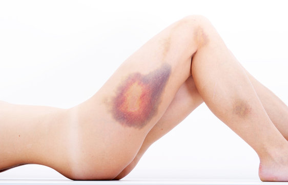 Young Woman With A Hematoma On Hip