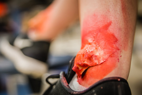 Moulage injuries