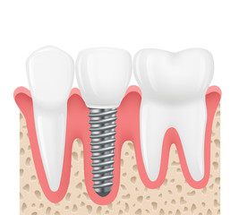 Realistic illustration tooth implant. Vector image human teeth. Implant replacement torn tooth.