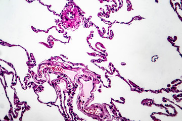 Fototapeta na wymiar Histopathology of lung emphysema, light micrograph, photo under microscope showing enlargement of air spaces in lung tissue and destruction of alveolar septa