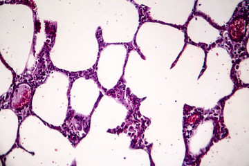 Histopathology of pneumonia, light micrograph, photo under microscope. Cellulose aspiration...