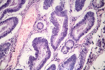 Histopathology of intestinal adenoma, light micrograph, photo under microscope
