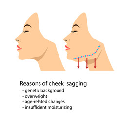 Face of a woman demonstrating aging changes in jaw angle