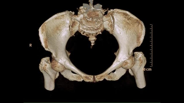 CT Scan of pelvic bone with both hip joint 3D rendering image rotating on the screen . medical technology concept.