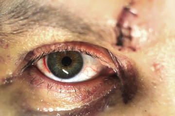 eye injury bruises and bruises. A blow to the eye.