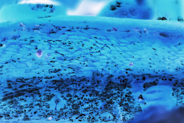 cancer cells under a microscope. Tissues affected by cancer cells under the microscope, Science....