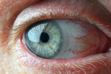 Eye with contact lens.