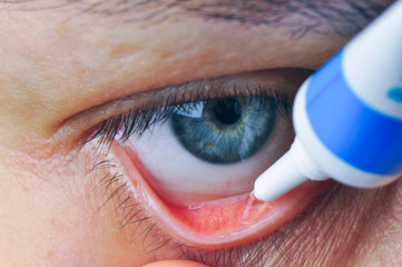 Instill eyedrops or ointment on eye. - obrazy, fototapety, plakaty