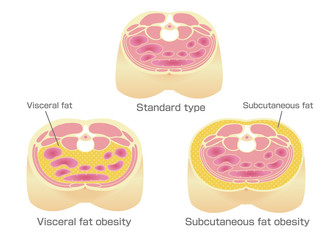 Type of obesity illustration. Abdominal sectional View. (visceral fat , subcutaneous fat)