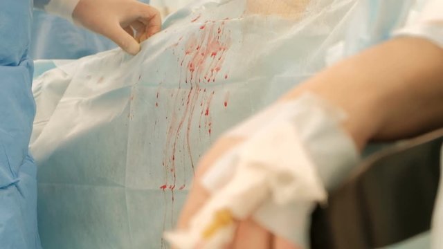 Operating room in the hospital. Endovideosurgery. The camera and point of focus moves from the hands of the surgeons to the arm of a fat female patient. Laparoscopic surgery. Closeup. Endo instruments
