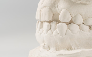Dental casting gypsum model of human jaws. Crooked teeth and distal bite. Shots were made before treatment with braces . Technical shots on gray background - obrazy, fototapety, plakaty