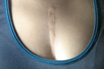 Scars from surgery