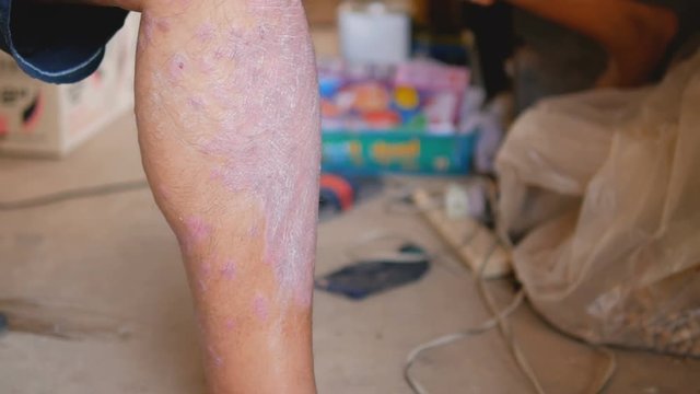 Psoriasis patients use herbal medicines to treat wounds on the left leg
