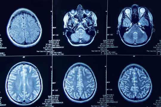 Photograph of magnetic resonance imaging of human brain
