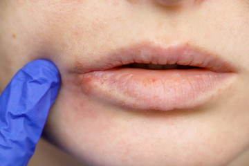 Herpes on the lips: a woman with a cold and the herpes virus is examined by a dermatologist and...