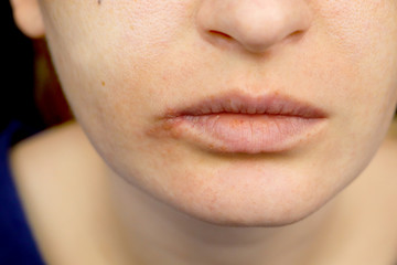 Herpes on the lips: a woman with a cold and the herpes virus is examined by a dermatologist and...