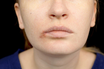Herpes on the lips: a woman with a cold and the herpes virus is examined by a dermatologist and...