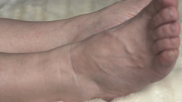 Varicose veins and thrombophlebitis in a woman's legs, close-up, circulation, vascular