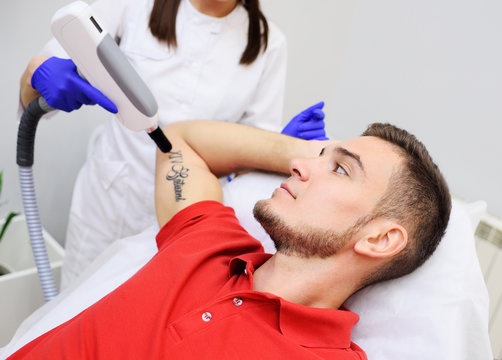 The Cosmetologist removes the patient's tattoo with a neodymium laser. Laser cosmetology