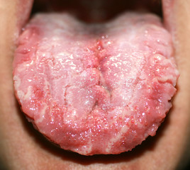 Geographic tongue, candidiasis, the language of the white coating candida