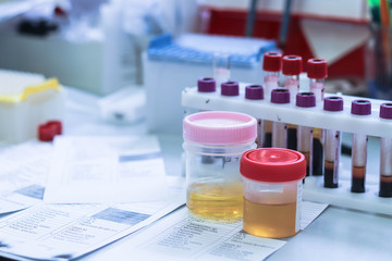 Urine samples in special tubes for examination. On the background of tubes with blood samples in the clinical laboratory