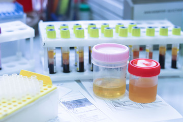 Urine samples in special tubes for examination. On the background of tubes with blood samples in the clinical laboratory