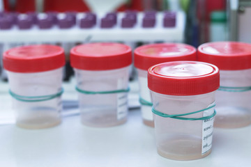 Sperm and urine samples in special test tubes for examination. On the background of tubes with blood samples in the clinical laboratory