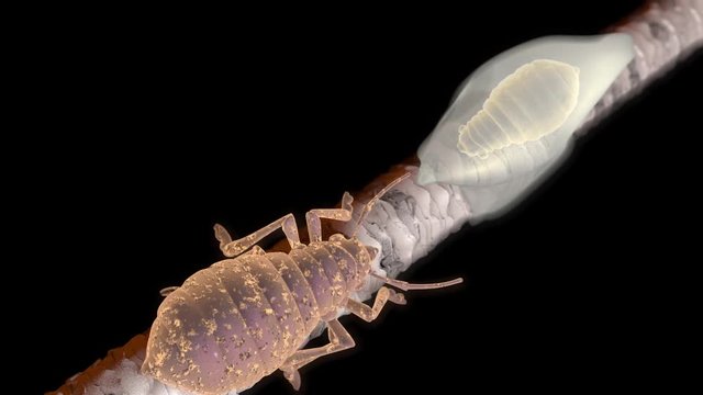 Lice on hair close up as a medical problem concept as follicles with an infestation of parasitic nits or eggs