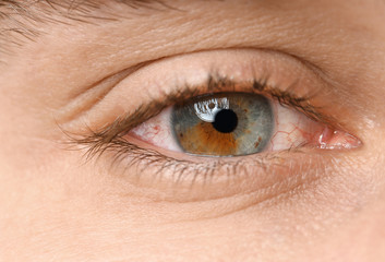 Young man suffering from allergy, closeup. Red eye