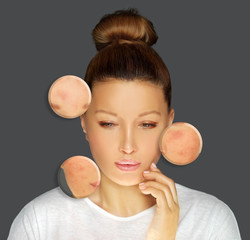 Post-Acne Marks /Treating Acne Scars