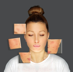 Post-Acne Marks /Treating Acne Scars