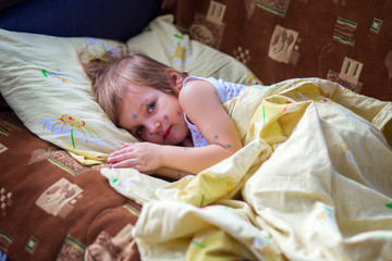 The child having chicken pox lies in a bed and has a rest
