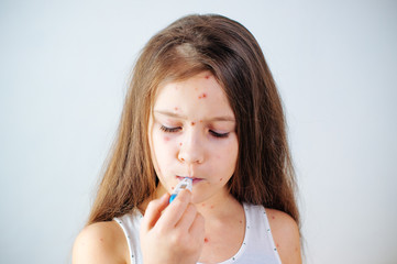 Closeup of cute sad little girl. Varicella virus or Chickenpox bubble rash on child