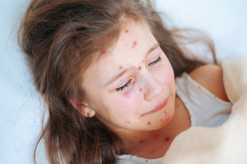 Closeup of cute sad crying little girl in bed. Varicella virus or Chickenpox bubble rash on child
