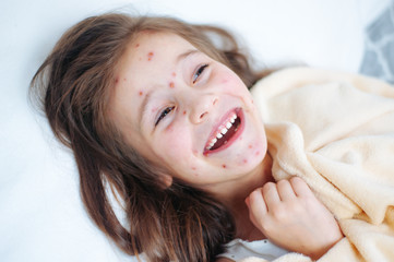 Closeup of cute smiles funny little girl in bed. Varicella virus or Chickenpox bubble rash on child