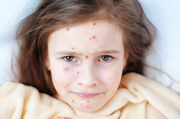 Closeup of cute sad little girl in bed. Varicella virus or Chickenpox bubble rash on child