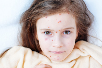 Closeup of cute sad little girl in bed. Varicella virus or Chickenpox bubble rash on child