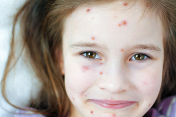 Closeup of cute smiles funny little girl. Varicella virus or Chickenpox bubble rash on child