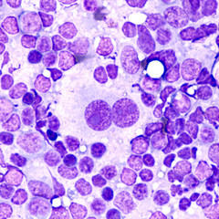 Microscopic image of touch prep cytology smear of a lymph node in a patient with Hodgkin's Disease...