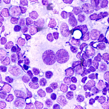 Microscopic image of touch prep cytology smear of a lymph node in a patient with Hodgkin's Disease (lymphoma), showing  Reed Sternberg cells (bi-nucleated cells with prominent nucleoli).