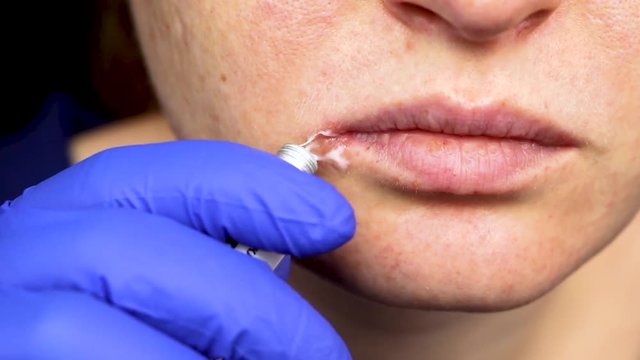Herpes on the lips: a woman with a cold and the herpes virus is examined by a dermatologist and infectious disease specialist