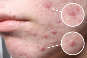 Young woman with acne problem before cosmetic surgery, closeup. Skincare concept