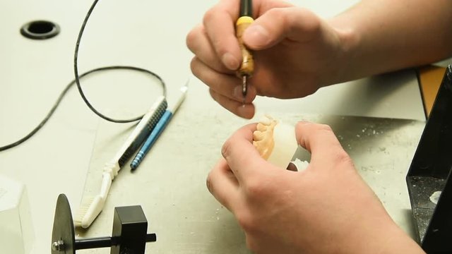 Dentist makes a dental implant prosthesis made of plaster cast. Orthopedic dentistry, prosthetics.