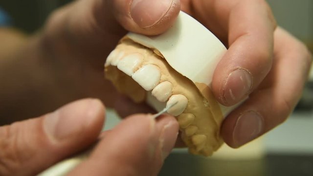 Dentist makes a dental implant prosthesis made of plaster cast. Orthopedic dentistry, prosthetics.