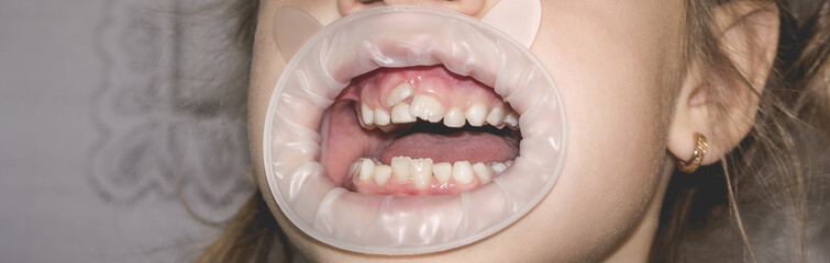 Adult permanent teeth coming in front of the child's baby teeth: shark teeth.