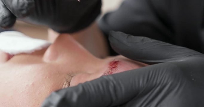 Closeup shot of womens eyebrows during a tattoo removal session. Hands in black gloves using a metal tool with micro needles.