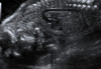 Newborn baby in picture ultrasound