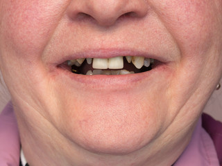 The teeth of the woman are processed and ready for prosthetics. Dental practice.